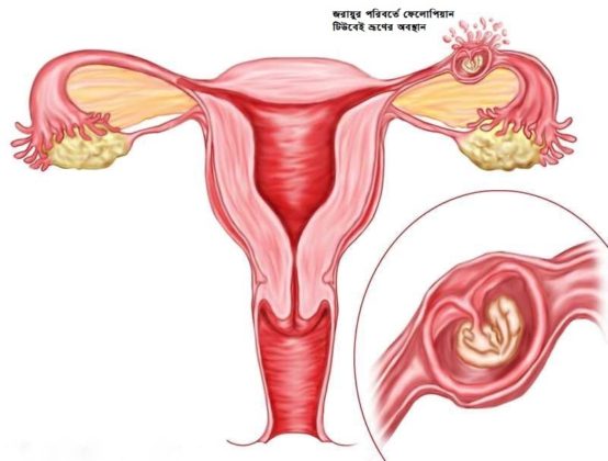 একটোপিক প্রেগন্যান্সি অপারেশন